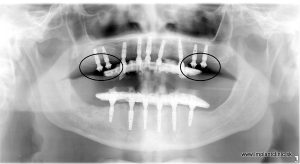 Snímka po odkrytí zubných implantátov