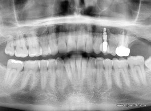 Nasadená implantátová zubná korunka