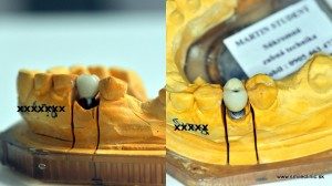 Vyrobená implantátová zubná korunka na modeli