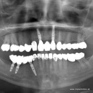 Zubné korunky a zubné implantáty