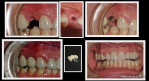 Koláž náhrady jedného zuba pomocou zubného implantátu