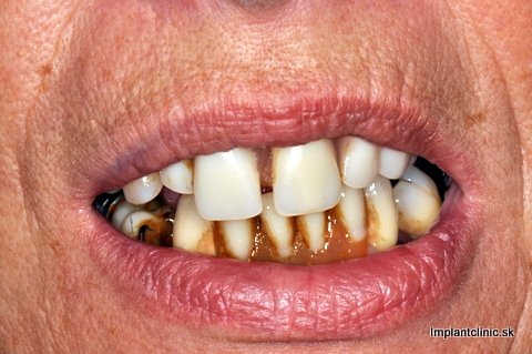 Vendy pred ošetrením