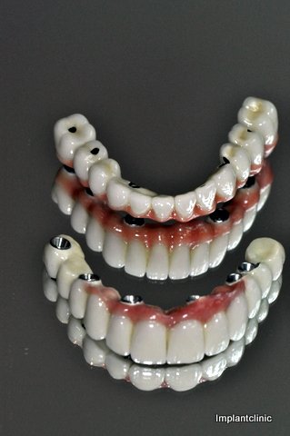 Implantová fixná protéza