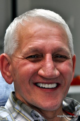 Filip po nasadení koruniek