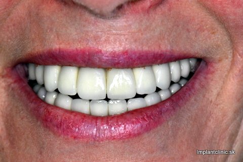 Po nasadení mostíka