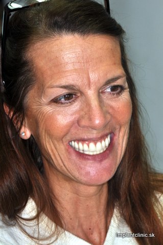 Vendy po nasadení koruniek