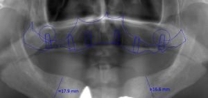 Chrup pred ošetrením