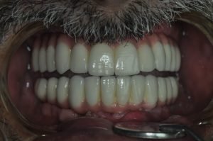 Pacientove zuby po ošetrení