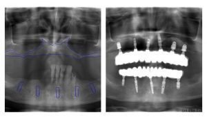 RTG snímka pred a po ošetrení